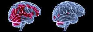 Cerebro antes y después de EMDR